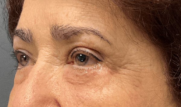 Blepharoplasty Before & After Gallery - Patient 255397 - Image 6