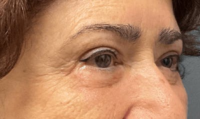 Blepharoplasty Before & After Gallery - Patient 255397 - Image 4