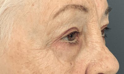 Blepharoplasty Before & After Gallery - Patient 293269 - Image 4