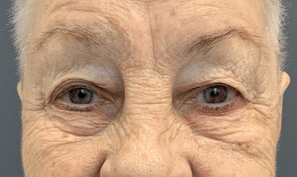 Blepharoplasty Before & After Gallery - Patient 293269 - Image 1