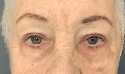 Blepharoplasty Before & After Gallery - Patient 293269 - Image 2