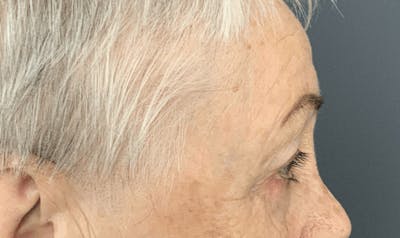 Blepharoplasty Before & After Gallery - Patient 293269 - Image 6