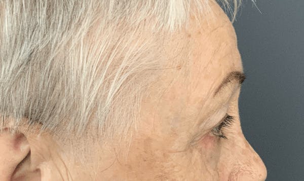 Blepharoplasty Before & After Gallery - Patient 293269 - Image 6