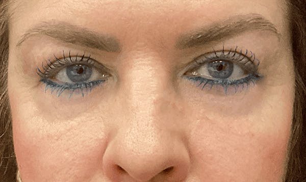 Blepharoplasty Before & After Gallery - Patient 269606 - Image 2