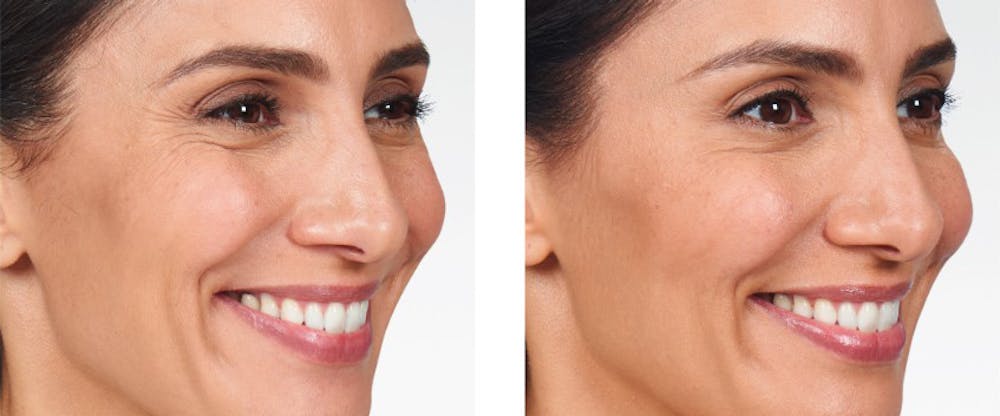 BOTOX & Fillers Before & After Gallery - Patient 5750201 - Image 1