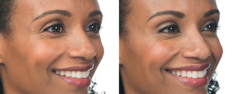BOTOX & Fillers Before & After Gallery - Patient 5750202 - Image 1