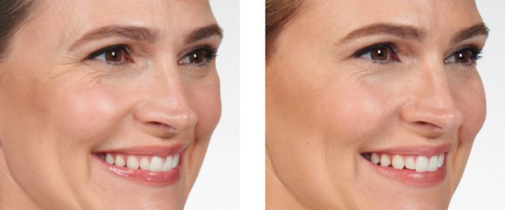 BOTOX & Fillers Before & After Gallery - Patient 5750203 - Image 1
