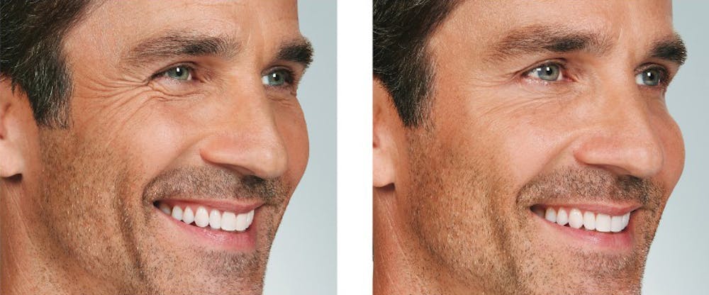 BOTOX & Fillers Before & After Gallery - Patient 5750205 - Image 1