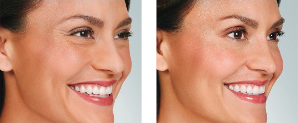 BOTOX & Fillers Before & After Gallery - Patient 5750204 - Image 1