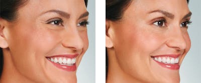BOTOX & Fillers Before & After Gallery - Patient 5750204 - Image 1
