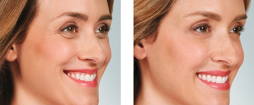BOTOX & Fillers Before & After Gallery - Patient 5750206 - Image 1
