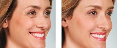 BOTOX & Fillers Before & After Gallery - Patient 5750206 - Image 1