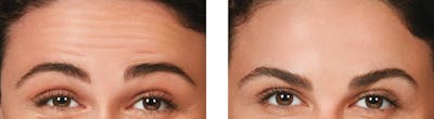 BOTOX & Fillers Before & After Gallery - Patient 5750208 - Image 1