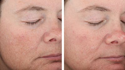 Skin Before & After Gallery - Patient 5750298 - Image 1