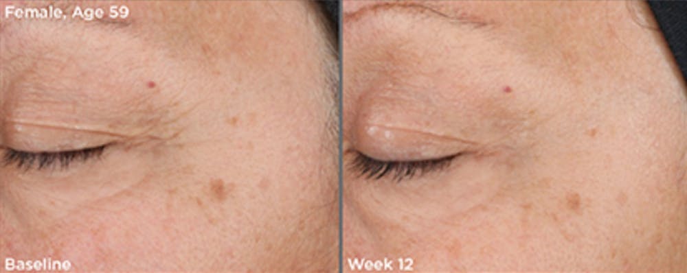 Skin Before & After Gallery - Patient 5750296 - Image 1