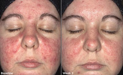 Skin Before & After Gallery - Patient 5750295 - Image 1