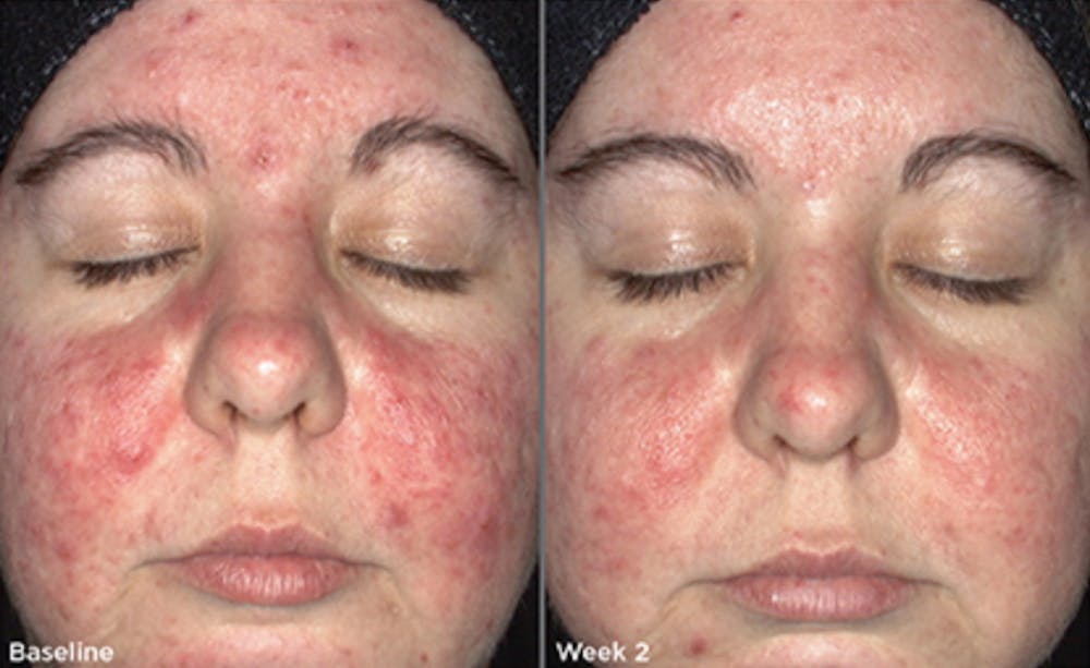 Skin Before & After Gallery - Patient 5750295 - Image 1