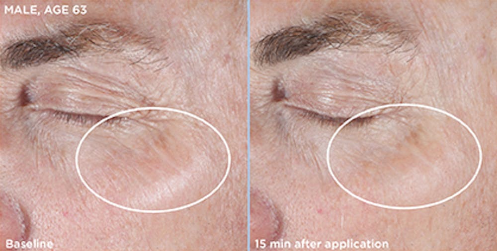 Skin Before & After Gallery - Patient 5750292 - Image 1