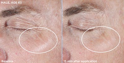 Skin Before & After Gallery - Patient 5750292 - Image 1
