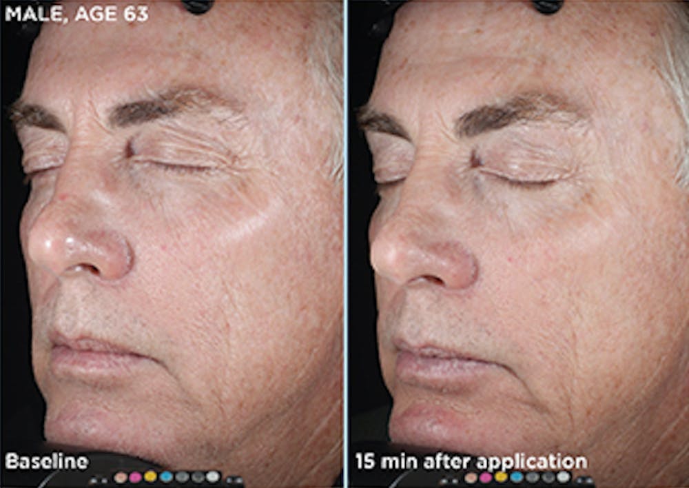 Skin Before & After Gallery - Patient 5750291 - Image 1