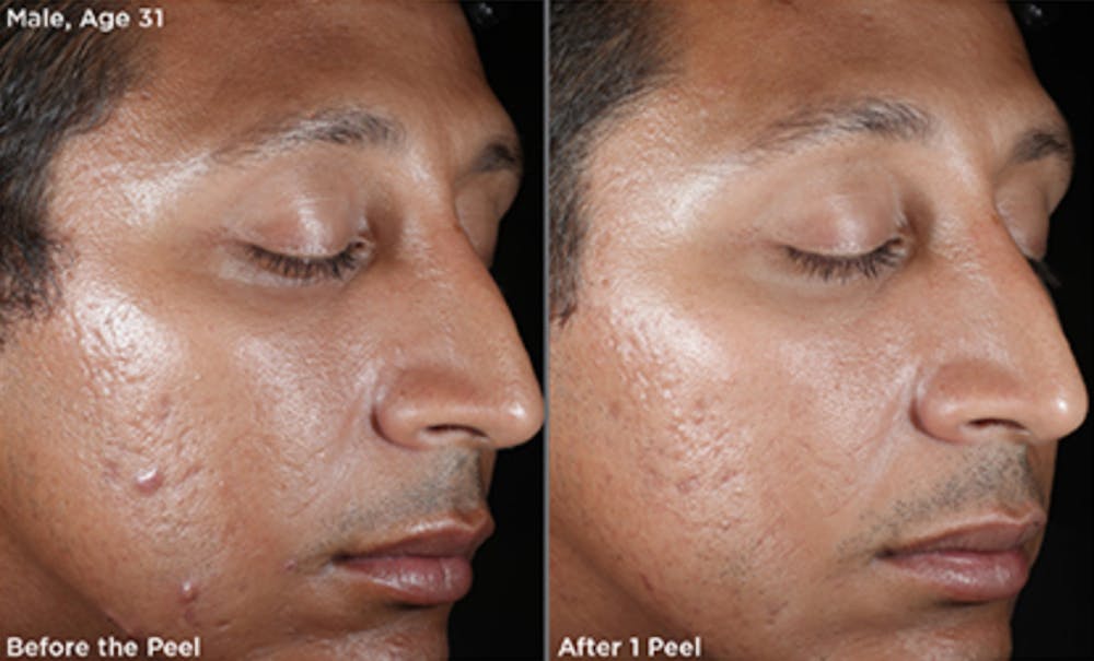 Skin Before & After Gallery - Patient 5750290 - Image 1