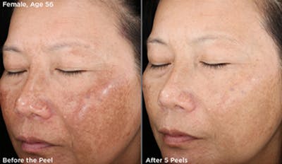 Skin Before & After Gallery - Patient 5750289 - Image 1