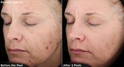 Skin Before & After Gallery - Patient 5750288 - Image 1