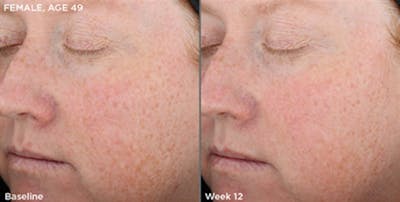 Skin Before & After Gallery - Patient 5750287 - Image 1