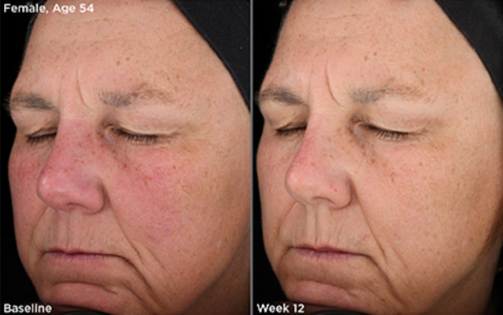 Skin Before & After Gallery - Patient 5750286 - Image 1