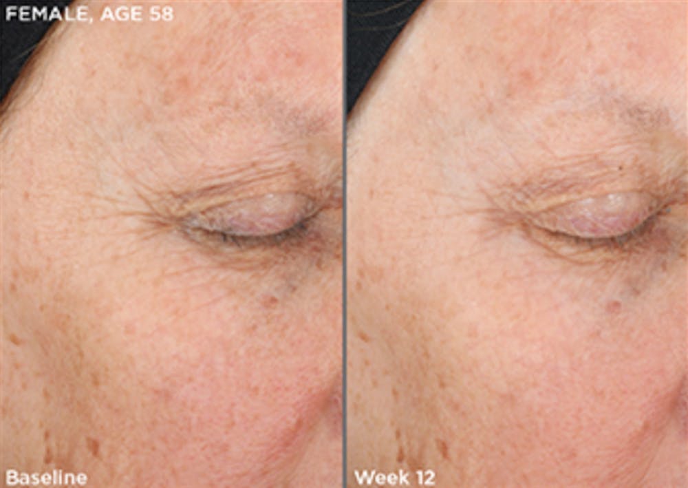 Skin Before & After Gallery - Patient 5750284 - Image 1