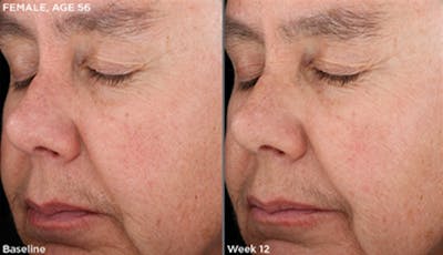 Skin Before & After Gallery - Patient 5750283 - Image 1