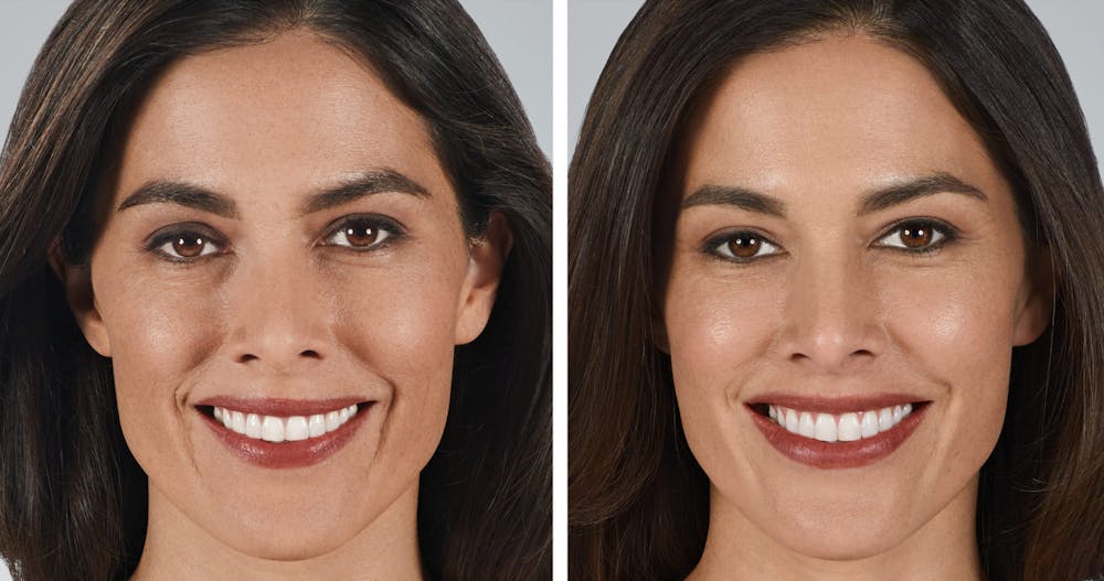 BOTOX & Fillers Before & After Gallery - Patient 122529392 - Image 1