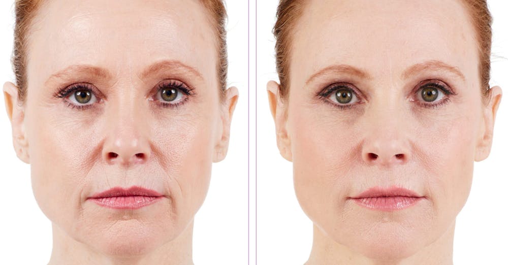 BOTOX & Fillers Before & After Gallery - Patient 122529416 - Image 1