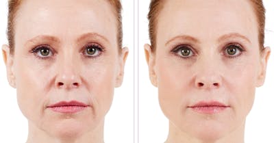 BOTOX & Fillers Before & After Gallery - Patient 122529416 - Image 1
