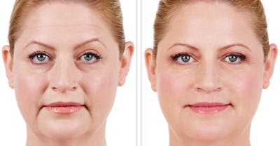 BOTOX & Fillers Before & After Gallery - Patient 122529417 - Image 1