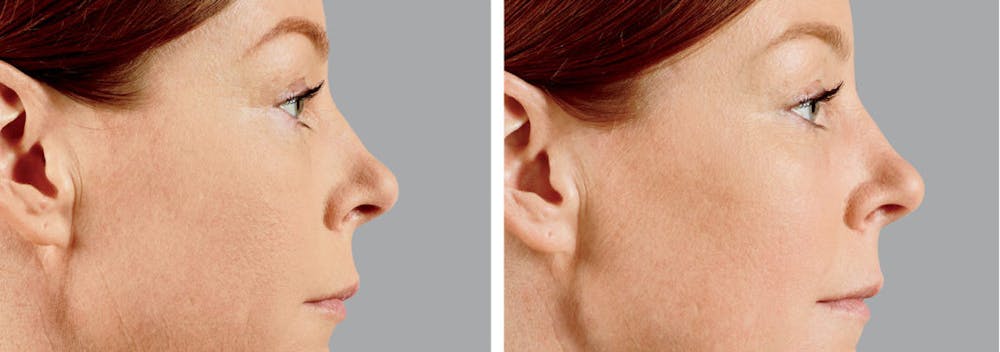 BOTOX & Fillers Before & After Gallery - Patient 122529418 - Image 1