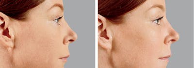 BOTOX & Fillers Before & After Gallery - Patient 122529418 - Image 1