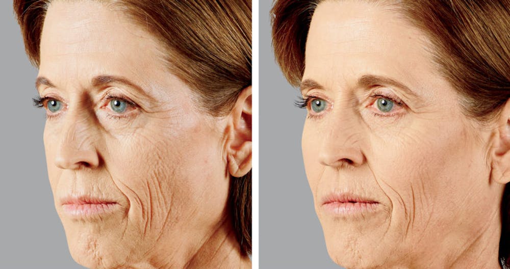 BOTOX & Fillers Before & After Gallery - Patient 122529419 - Image 1