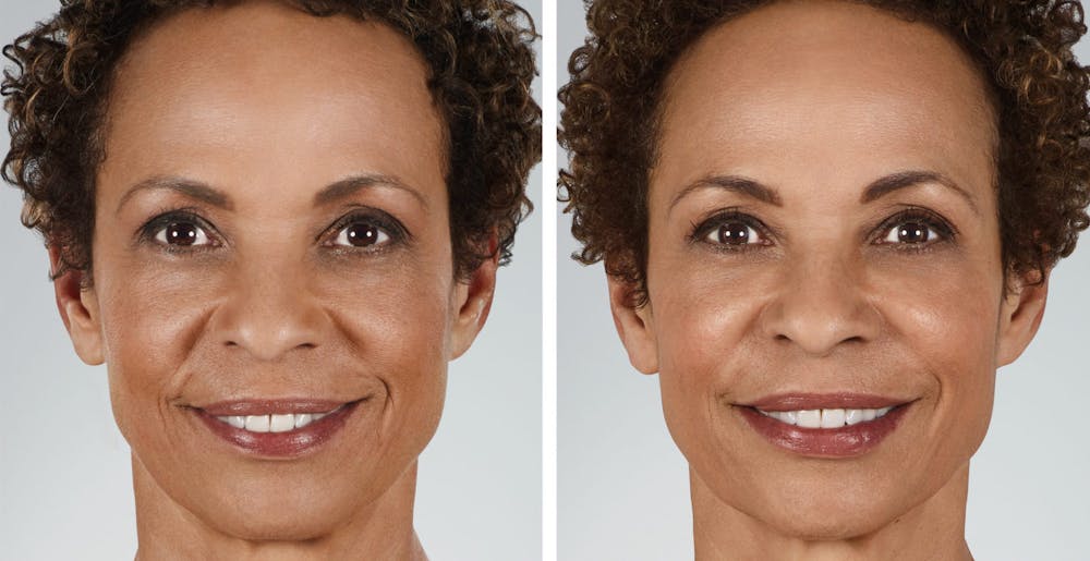 BOTOX & Fillers Before & After Gallery - Patient 122529421 - Image 1
