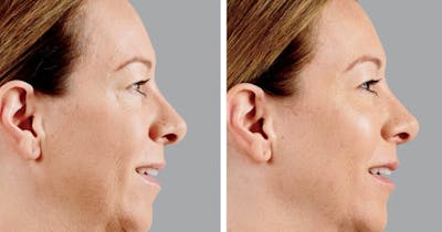 BOTOX & Fillers Before & After Gallery - Patient 122529415 - Image 1