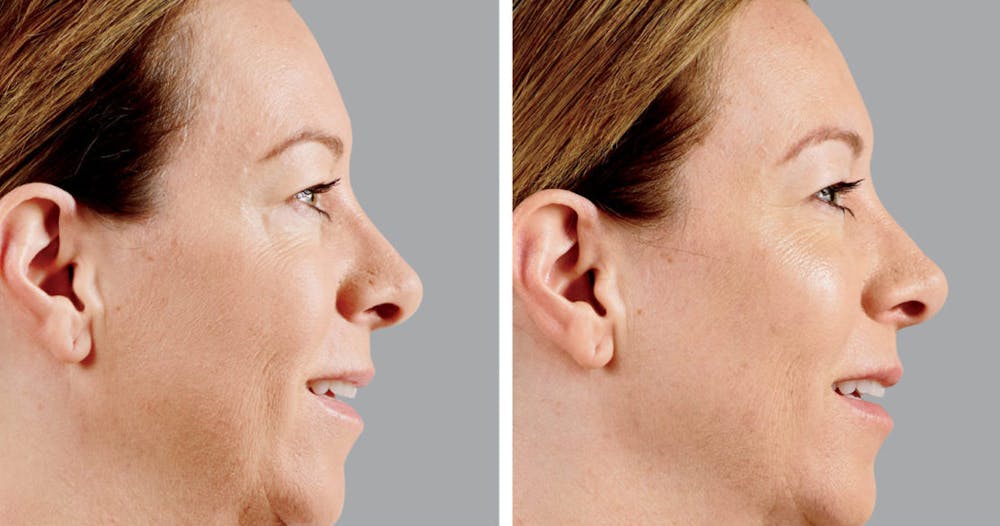 BOTOX & Fillers Before & After Gallery - Patient 122529415 - Image 1