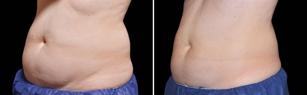 CoolSculpting Before & After Gallery - Patient 5750234 - Image 1