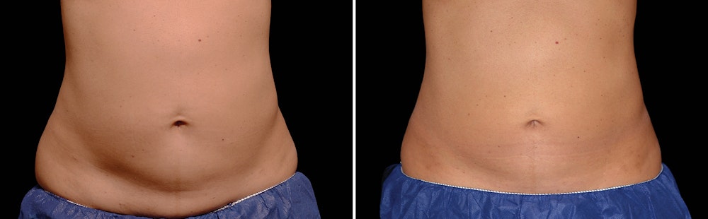 Coolsculpting