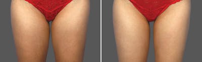 CoolSculpting Before & After Gallery - Patient 5750410 - Image 1