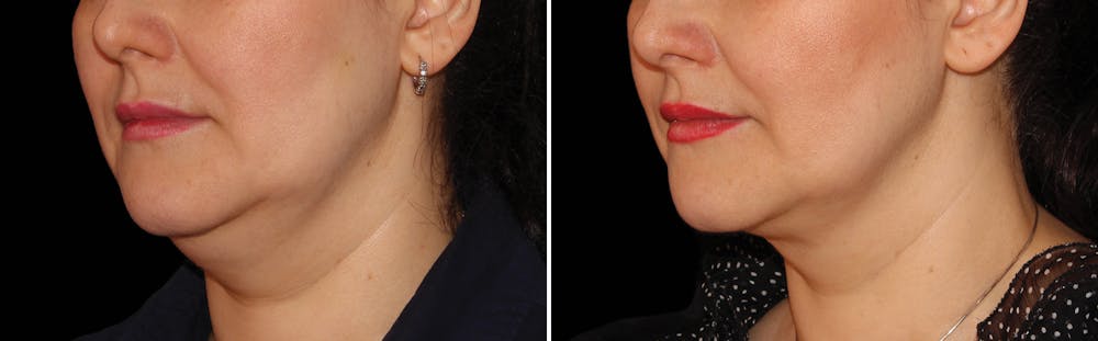CoolSculpting Before & After Gallery - Patient 5750411 - Image 1