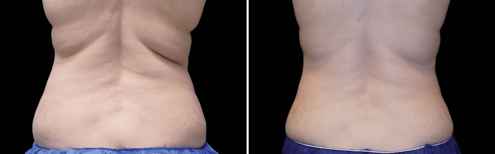 Before and After Coolsculpting Fort Collins