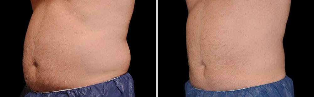 CoolSculpting Gallery - Patient 5750413 - Image 1