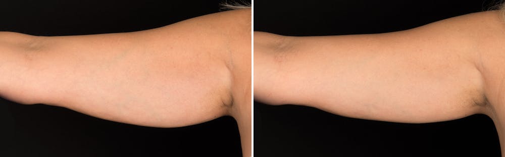 CoolSculpting Before & After Gallery - Patient 5750414 - Image 1