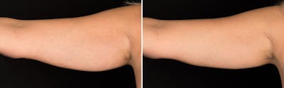 CoolSculpting Before & After Gallery - Patient 5750414 - Image 1