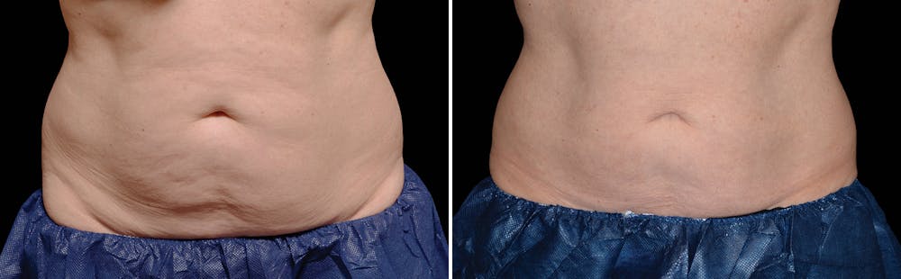 CoolSculpting Before & After Gallery - Patient 5750460 - Image 1